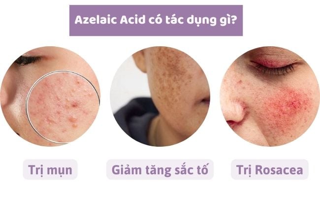 Azelaic Acid có tác dụng gì?