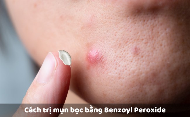 Cách trị mụn bọc bằng Benzoyl Peroxide

