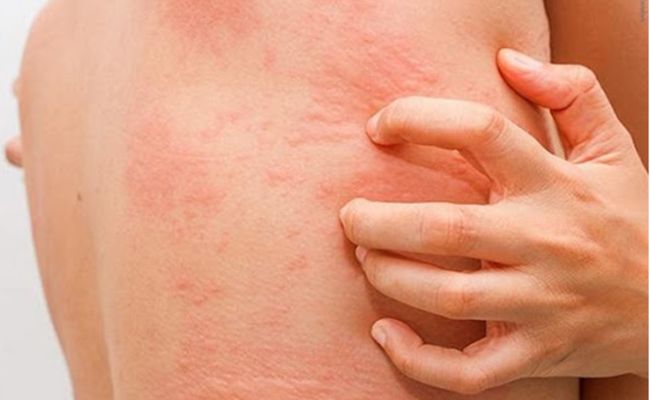 Hình ảnh viêm da tiếp xúc dị ứng