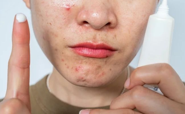 Cách trị mụn tuổi dậy thì bằng Acid azelaic