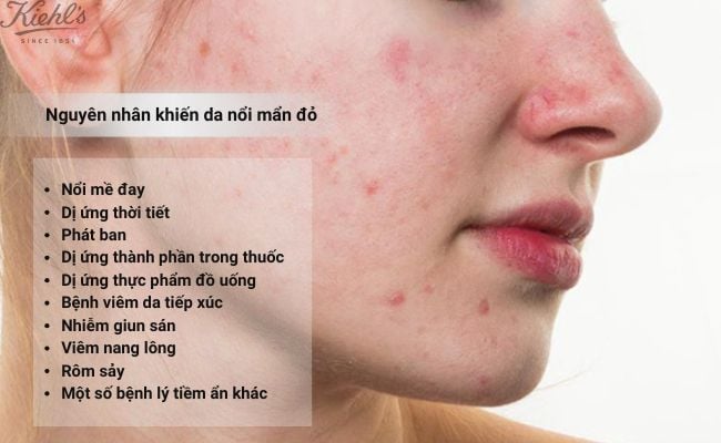 Nguyên nhân khiến da nổi mẩn đỏ