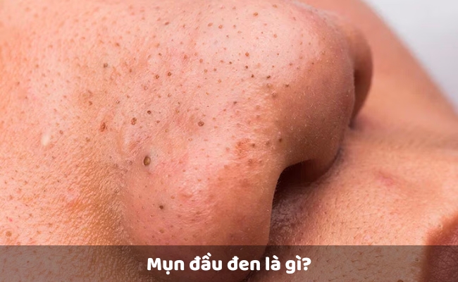 Có nên lột mụn đầu đen không?