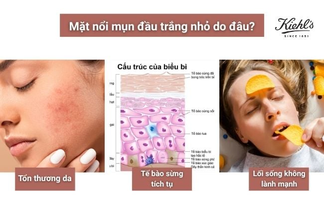 Mặt nổi mụn đầu trắng nhỏ do đâu?