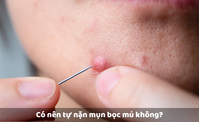 Có nên tự nặn mụn bọc mủ không?
