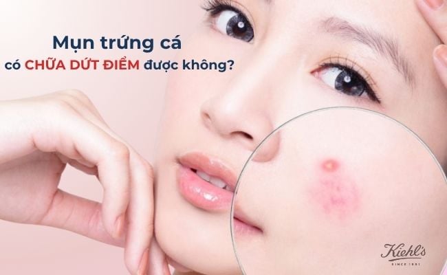 Mụn trứng cá có chữa dứt điểm được không?
