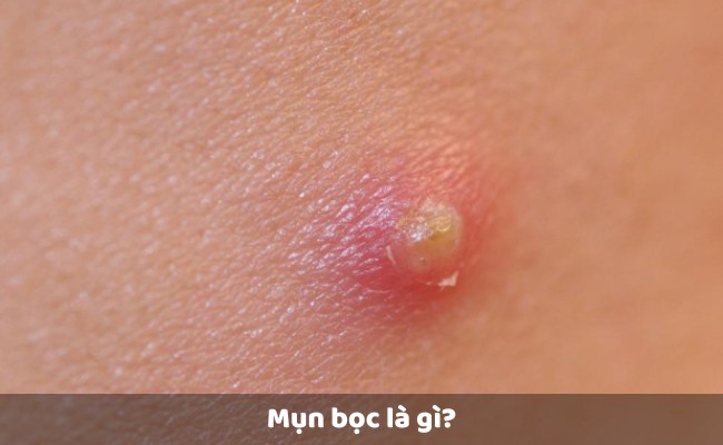 Mụn bọc là gì?