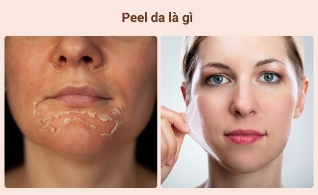 Peel da là gì? Peel da hóa học là gì?