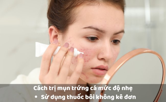 Cách trị mụn trứng cá mức độ nhẹ

