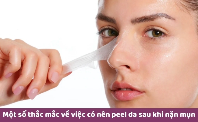 Một số thắc mắc về việc có nên peel da sau khi nặn mụn không?” height=