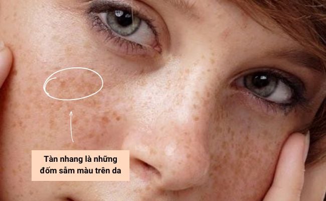 Tàn nhang là gì? Các loại tàn nhang 