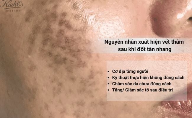 Tình trạng xuất hiện vết thâm sau khi đốt tàn nhang