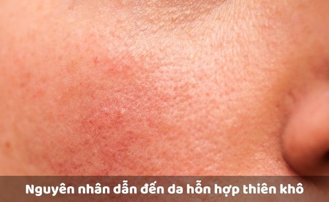 Nguyên nhân dẫn đến da hỗn hợp thiên khô 

