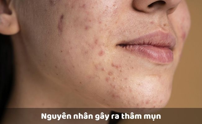 Nguyên nhân gây thâm mụn là gì?
