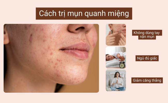Không được dùng tay nặn mụn khi bị mụn quanh miệng