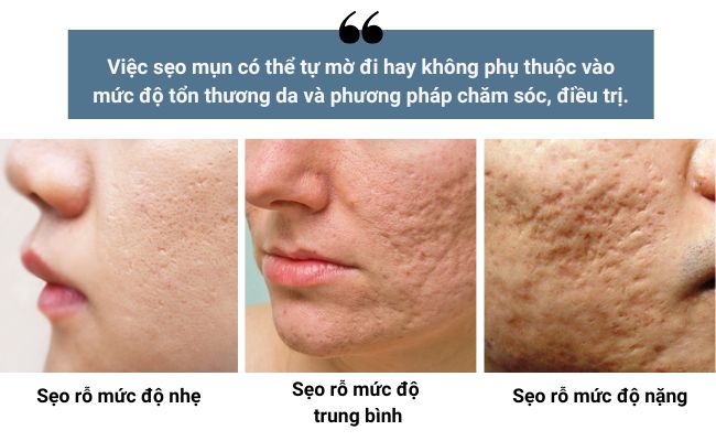 Sẹo mụn có thể tự hết không?