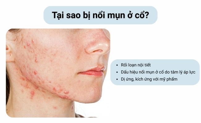 Các nguyên nhân phổ biến khiến mụn bùng phát ở vùng cổ và các vùng khác trên cơ thể.