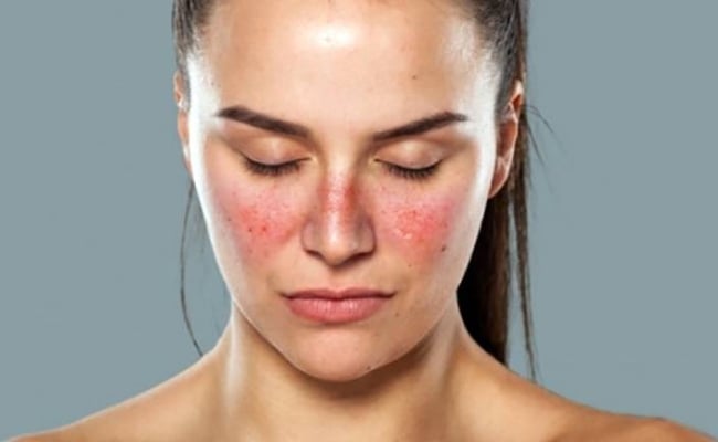tác dụng phụ của Benzoyl Peroxide