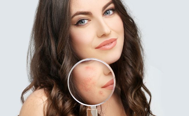 Lactic Acid làm mờ vết thâm mụn, giúp da trắng sáng, đều màu

