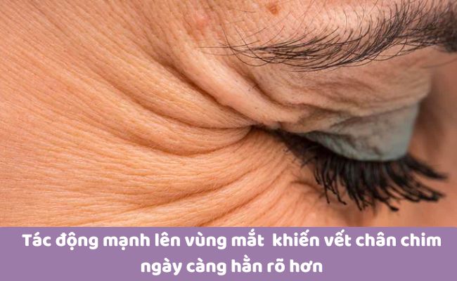 Nguyên nhân hình thành vết chân chim ở mắt