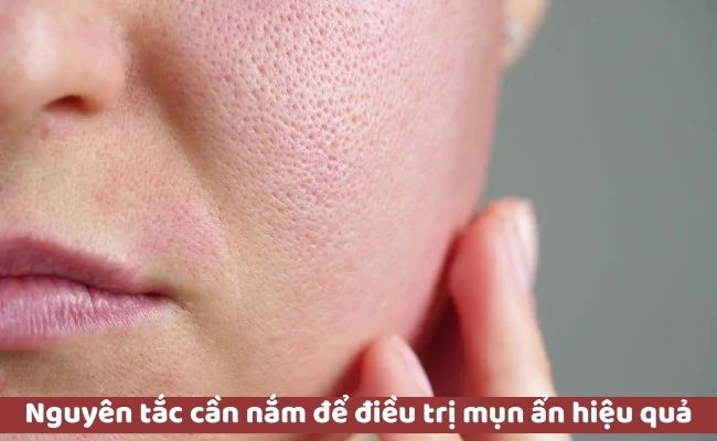 Nguyên tắc cần nắm để điều trị mụn ẩn hiệu quả
