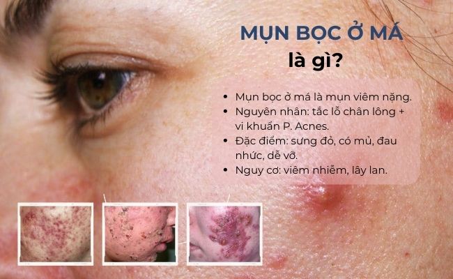 Mụn bọc ở má là gì?