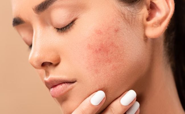 Nổi mẩn đỏ ở da mặt có nguy hiểm không?