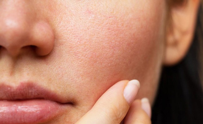 Nguyên nhân mặt nổi mụn trắng nhỏ