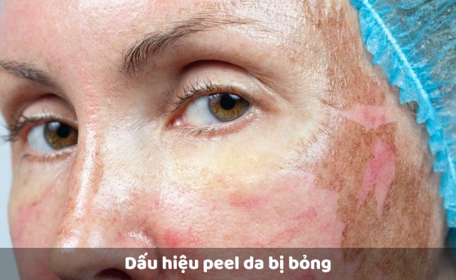 Dấu hiệu peel da bị bỏng