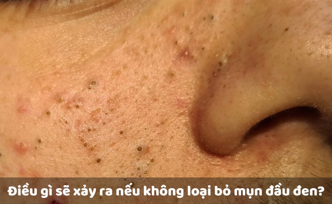 Điều gì sẽ xảy ra nếu không loại bỏ mụn đầu đen?