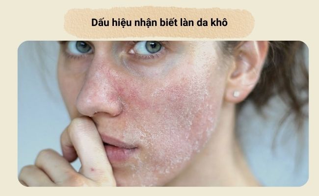 Dấu hiệu nhận biết làn da khô