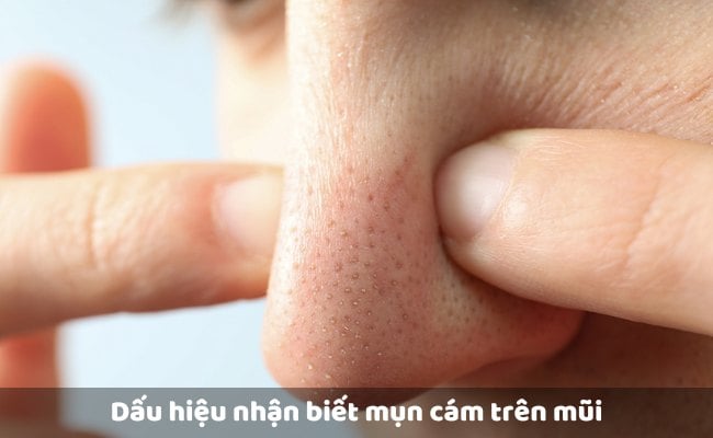 Dấu hiệu nhận biết mụn cám trên mũi