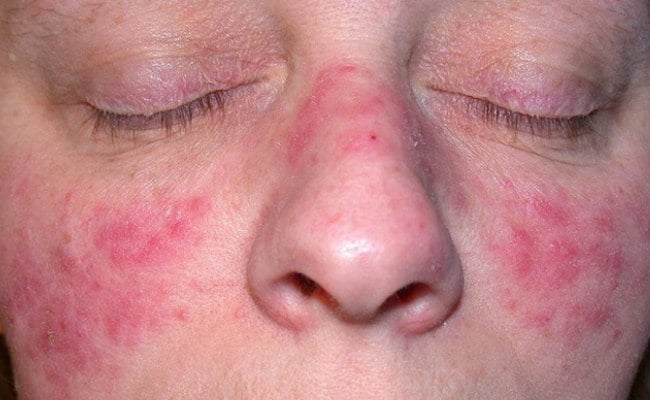 Lupus ban đỏ gây phát ban đỏ trên da

