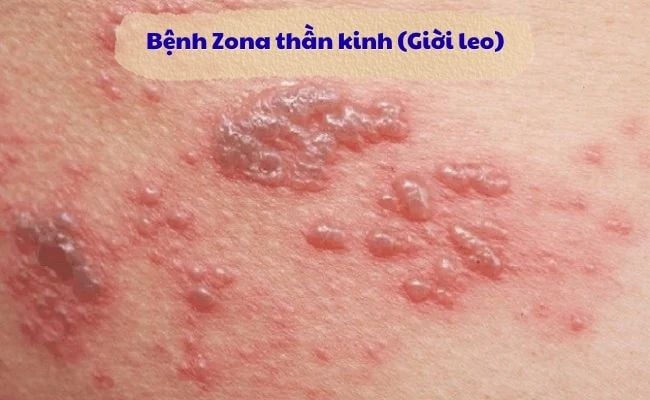 Bệnh Zona thần kinh (Giời leo)