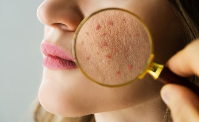 Nên dùng Retinol hay Tretinoin?