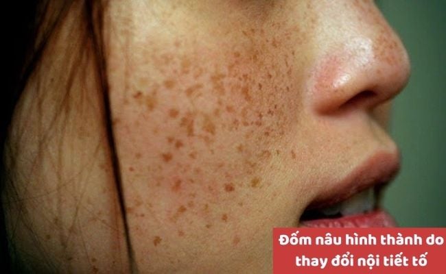 Nguyên nhân nổi đốm nâu
