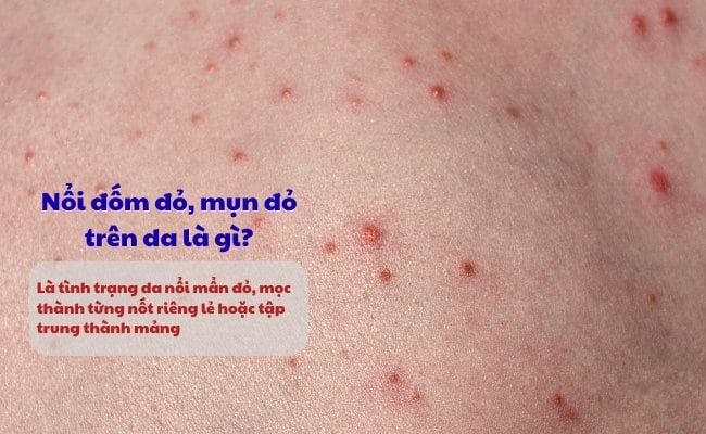 Nổi đốm đỏ, mụn đỏ trên da là gì? Triệu chứng như thế nào?