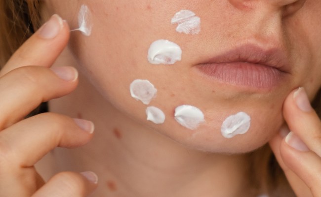 Những điều cần lưu ý về vị trí mụn trên mặt