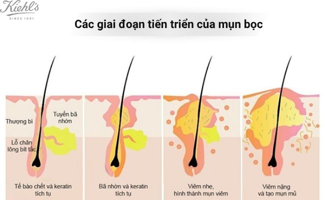 Các giai đoạn tiến triển của mụn bọc
