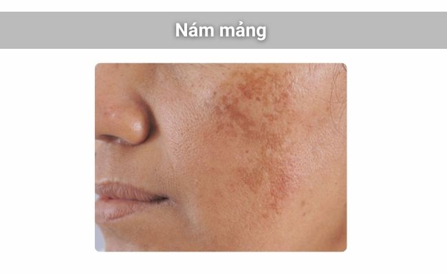 Mảng nám thường có màu nâu nhạt hoặc xám xanh, kích thước 2–4cm và dễ lan rộng