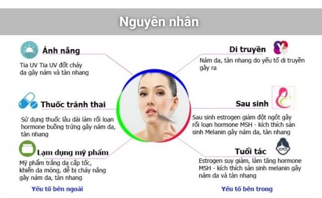 Nguyên nhân gây các loại nám da bao gồm yếu tố nội sinh và ngoại sinh