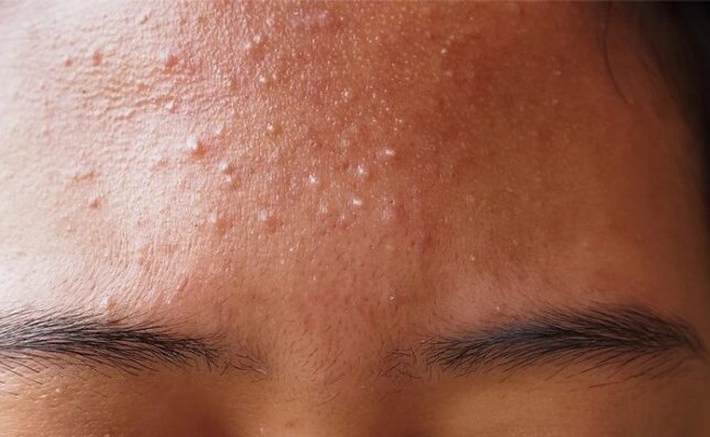 Mụn trắng nhỏ ở mặt là gì?
