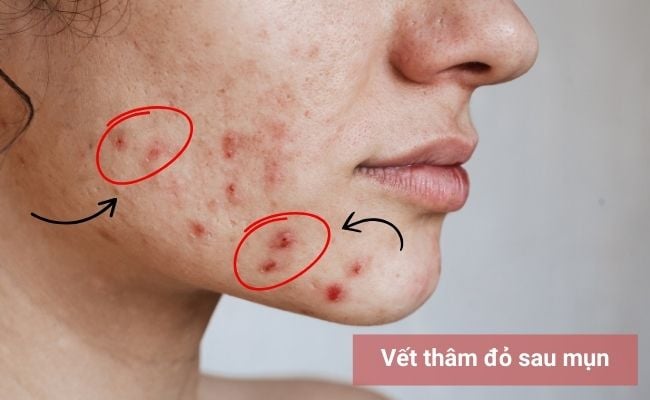 Thâm đỏ sau mụn là gì?