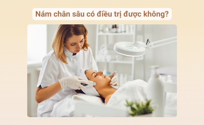 Mô tả quá trình điều trị nám chân sâu bằng các sản phẩm đặc trị chứa thành phần làm sáng và ức chế melanin.