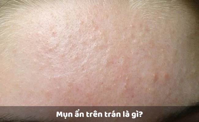 Mụn ẩn trên trán là gì?