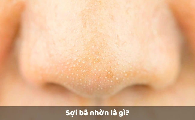 Sợi bã nhờn là gì?
