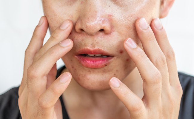 Tuỳ vào các đặc điểm khác nhau mà có thể chia làm nhiều loại mụn