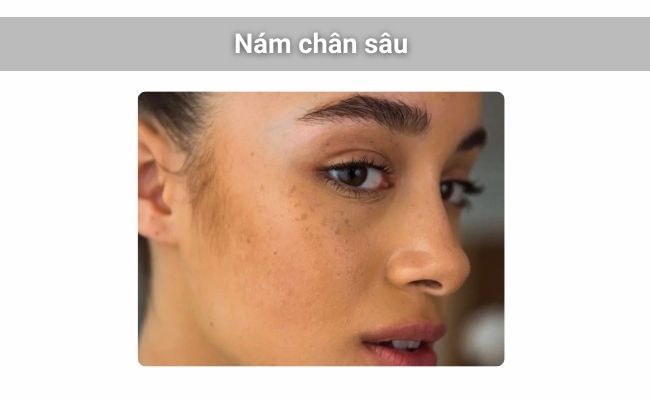 Nám chân sâu (hay nám đốm, nám chân đinh) là dạng nám xuất hiện dưới dạng các đốm nâu sẫm trên da