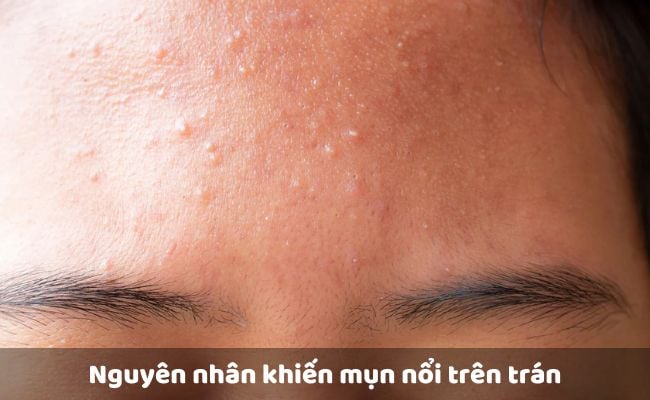Nguyên nhân khiến mụn nổi trên trán