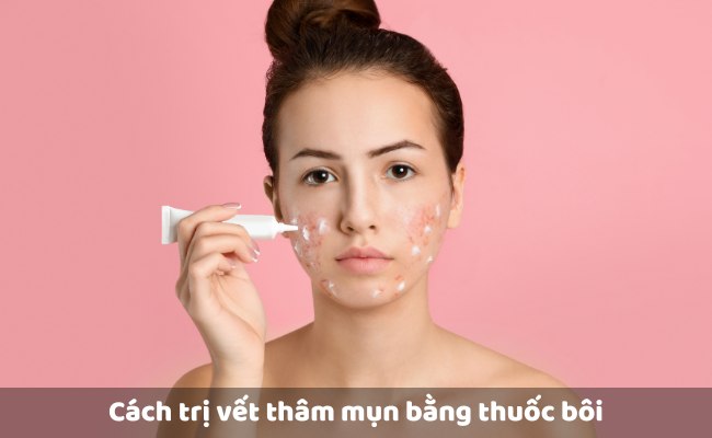 Dùng thuốc bôi để điều trị vết thâm mụn mãi không hết 

