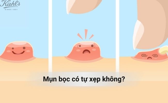 Mụn bọc có tự xẹp không?

